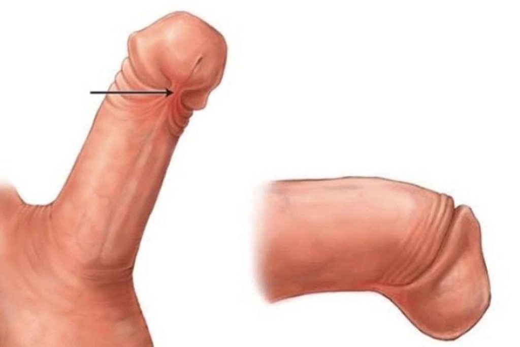 Frenuloplasty Surgical Treatment