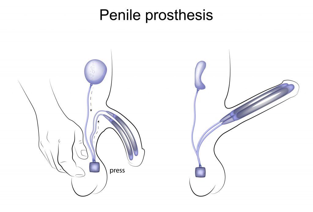 What are penile implants?